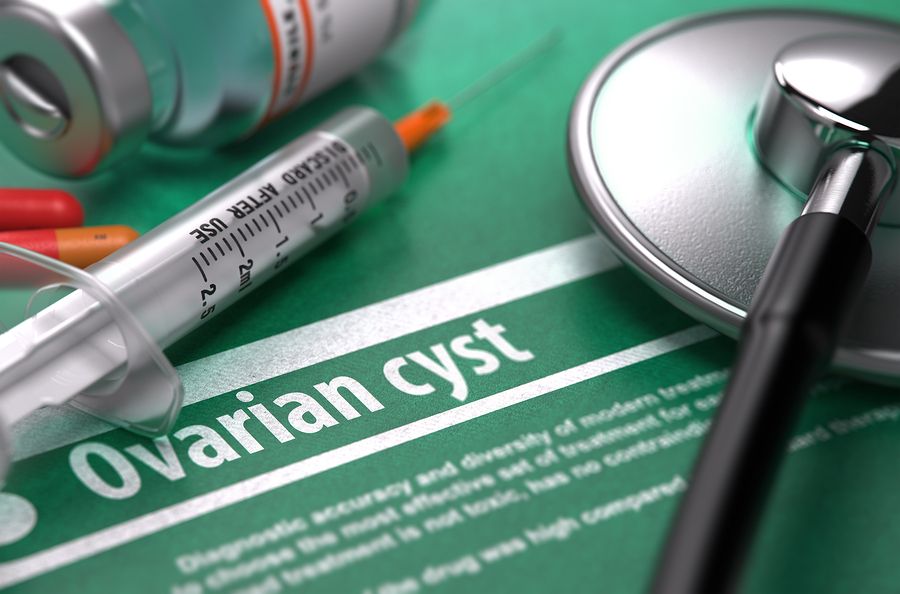 bigstock Ovarian cyst Medical Concept 110794661
