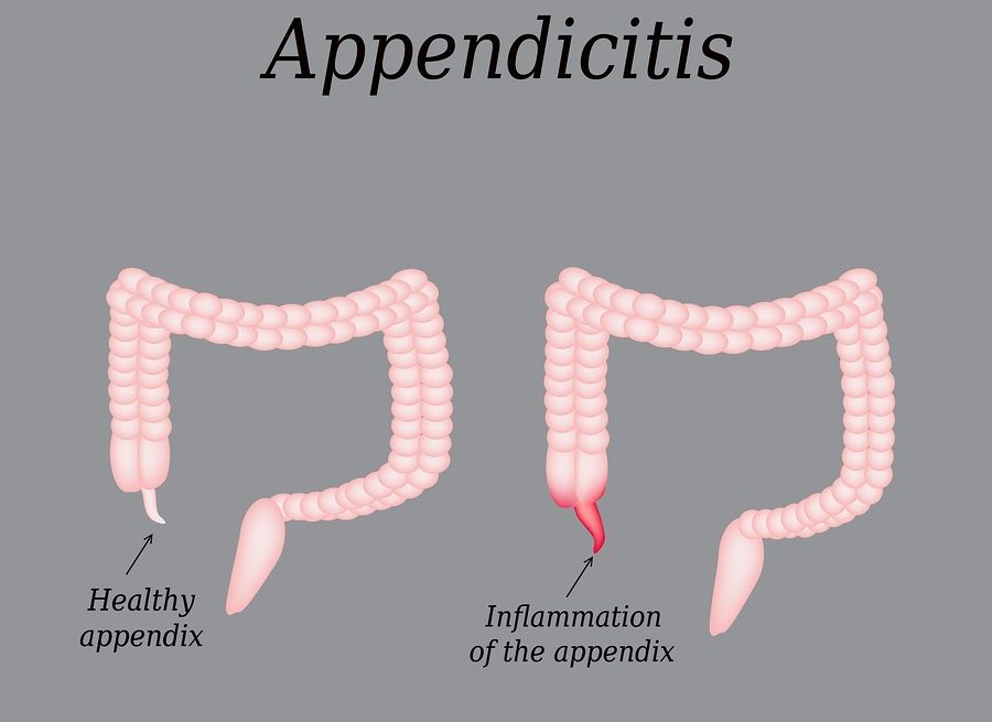bigstock Appendicitis Inflammation of 99345956