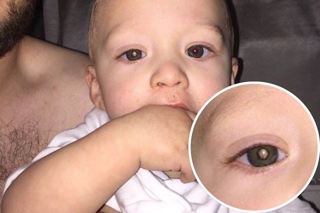 baby cancer eye photo owen scrivens jaxson emily smith12