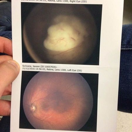 baby cancer eye photo owen scrivens jaxson emily smith3