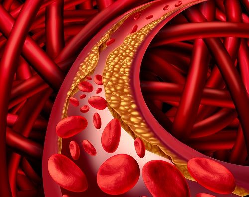 bigstock Artery Disease 96386159