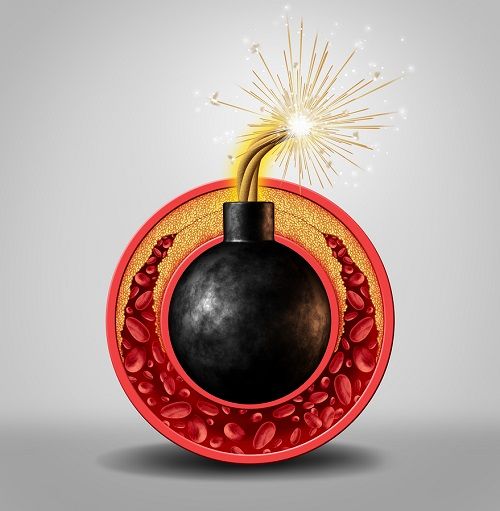 bigstock Cholesterol Time Bomb 97017614