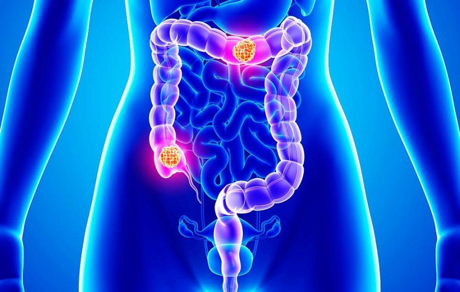 colon and rectal cancers