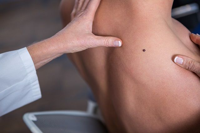 bigstock Dermatologist examining mole o 172679078