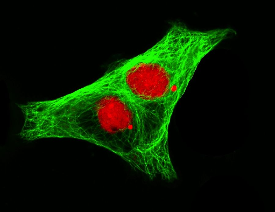 neuroblastoma