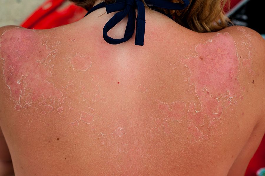sunburn 3
