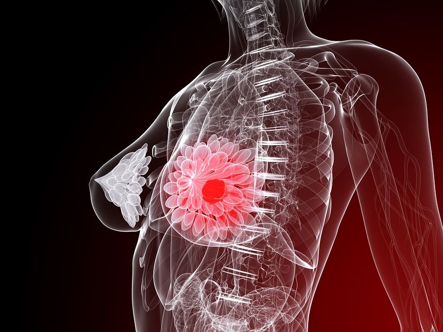 breast cancer 3