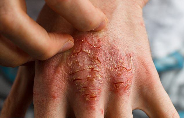 psoriasis