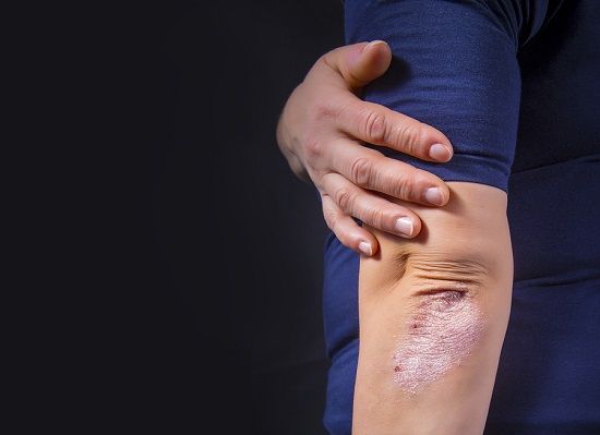 bigstock Psoriasis On Elbow 198066916