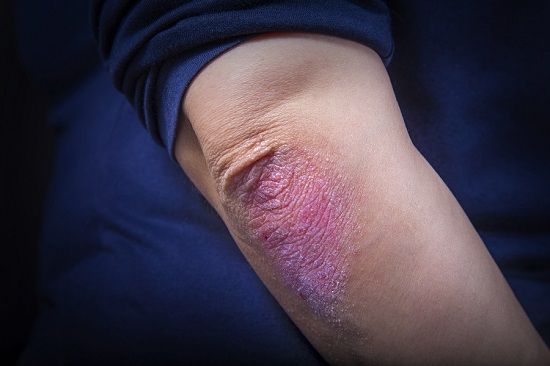 bigstock Psoriasis On Elbow 198068749