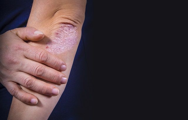 bigstock Psoriasis On Elbow 198068125
