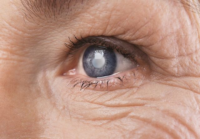 bigstock Cataract concept Senior woman 175059043