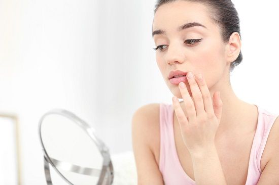 bigstock Young woman with cold sore loo 175720870