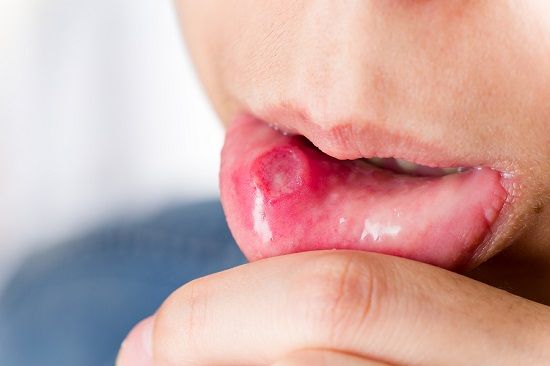 bigstock Mouth aphtha 70808170
