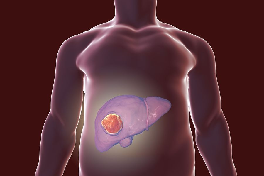 liver cancer