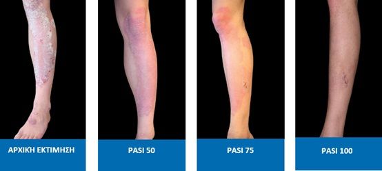 psoriasis 3