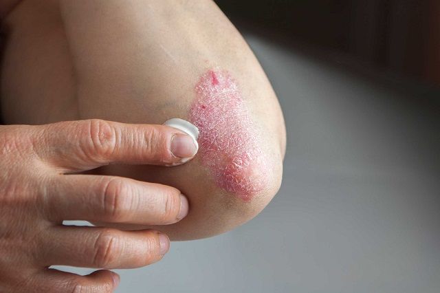 02 Little Body Changes that Reveal a Lot About Your Health scaly patch 497413495 Suze777