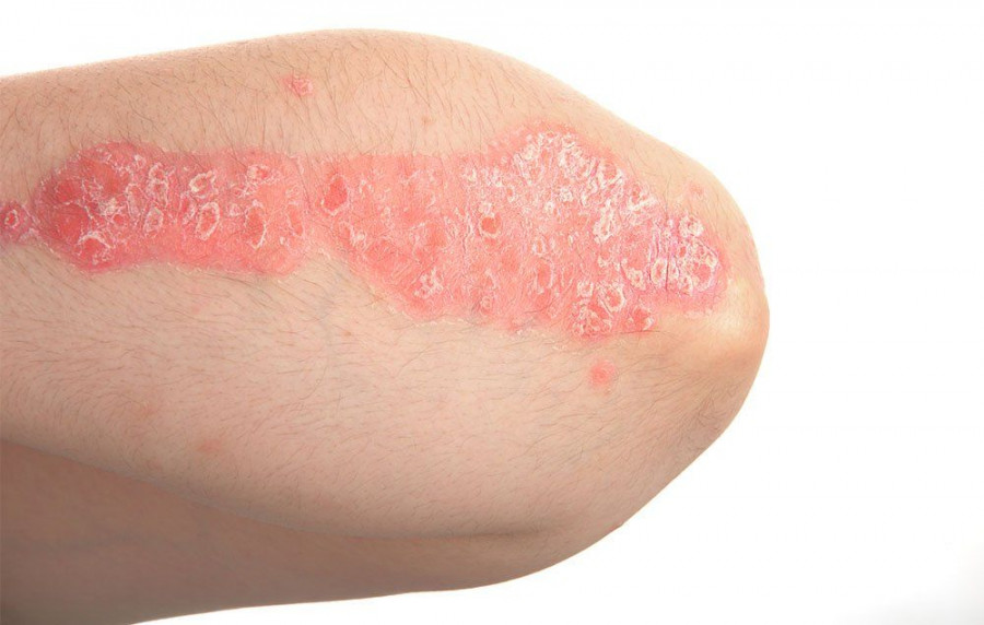 psoriasis arm