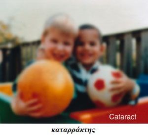 katarraktis