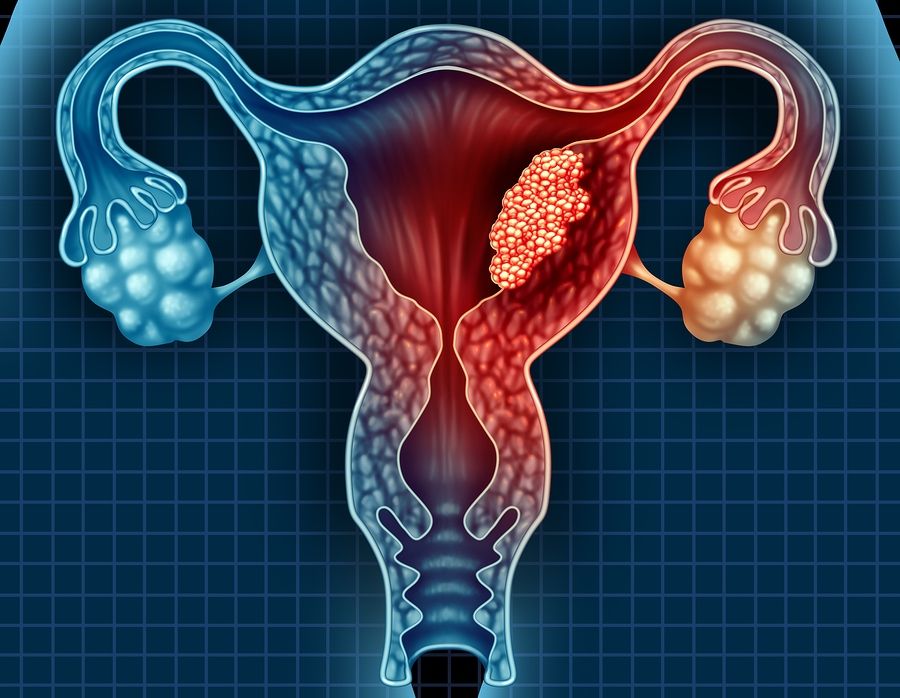 cervical cancer