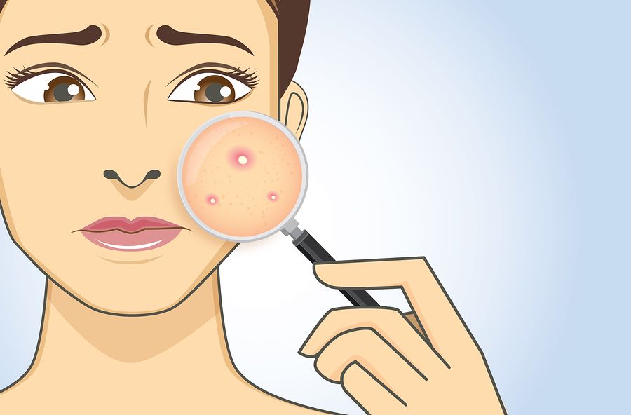 acne with magnifier