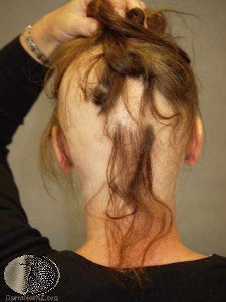 alopekia