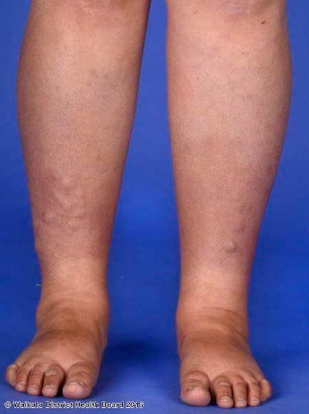 myxoedema