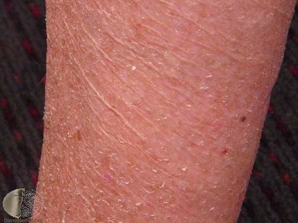 xiro derma