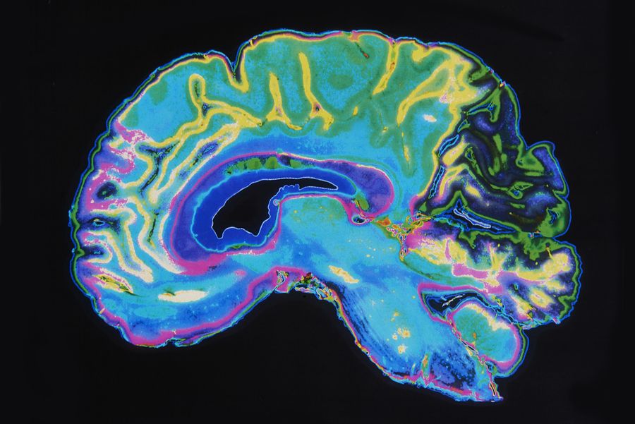 brain dementia