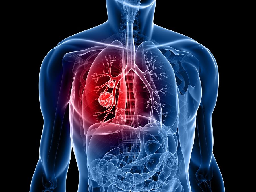 adenokarkinoma