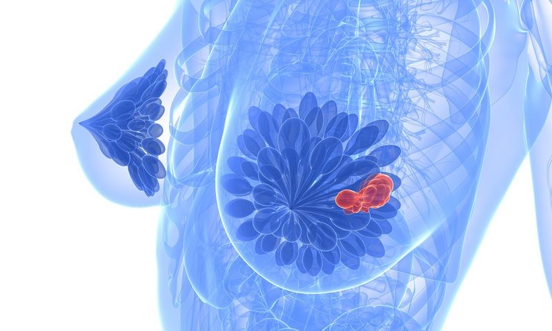 bigstock breast cancer 7059558