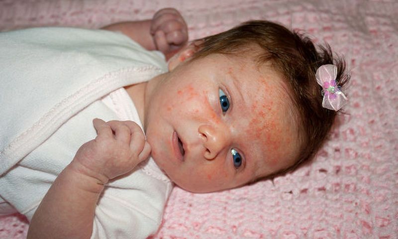 satopiki dermatitida