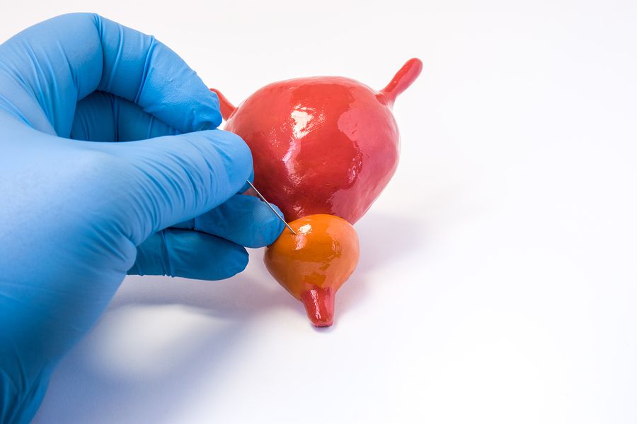 bigstock Prostate Gland Tissue Biopsy P 285384586
