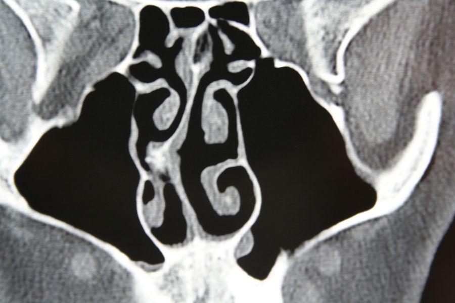 bigstock Deviated Septum 305061