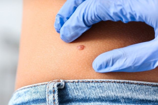 melanoma2