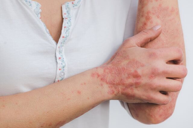 psoriasi 2