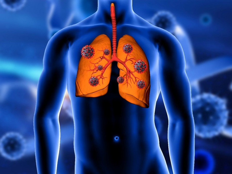pneumones-covid.jpg