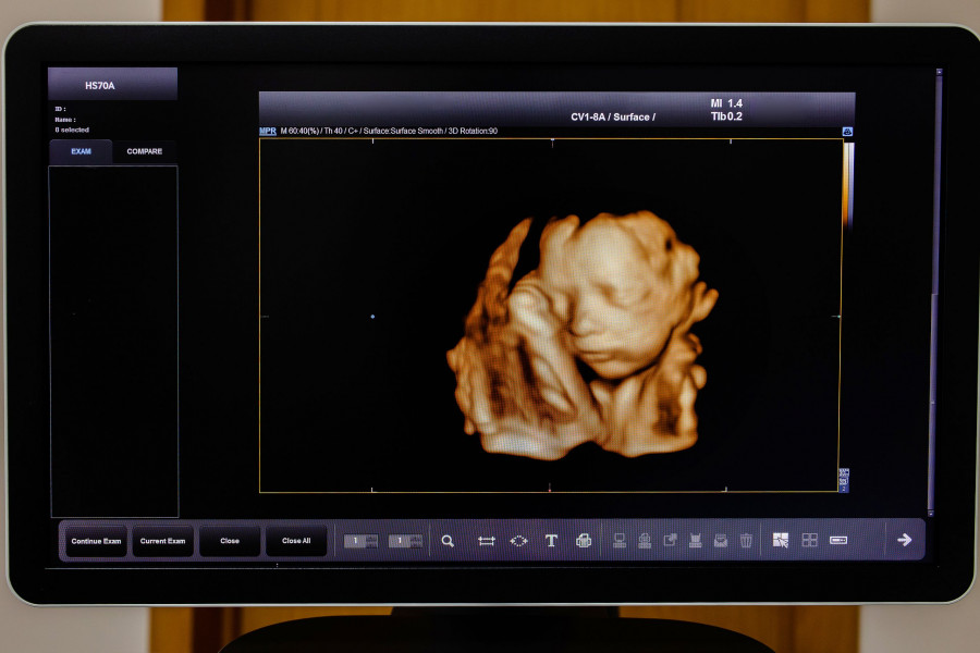 Image Ultrasound 3d Or 4d Of Baby In Mother's Womb. Picture 4d With Ultrasound Of Baby In Mother's W